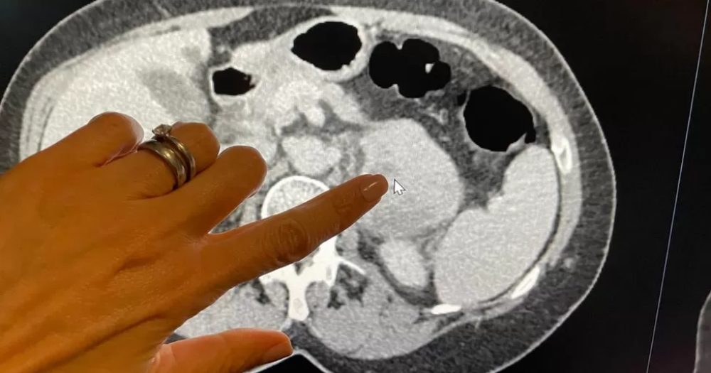 AI cancer detection