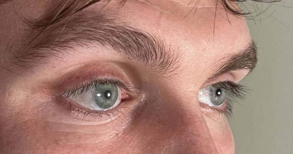 3D-printed prosthetic eyes
