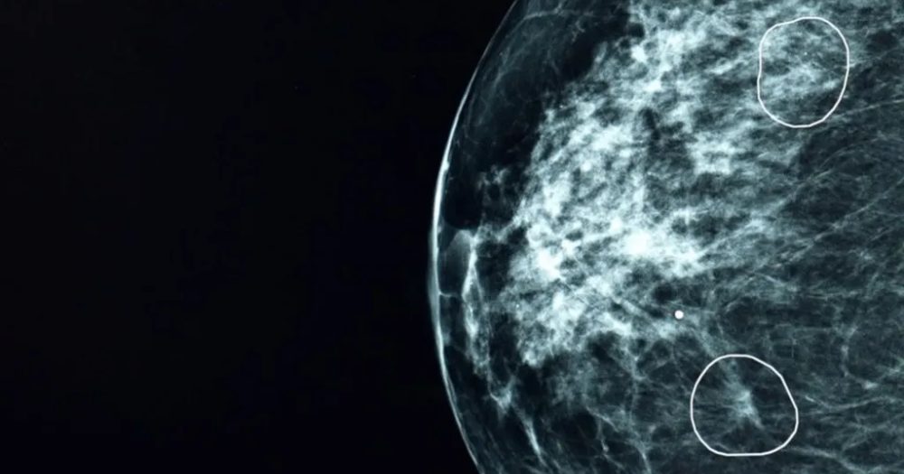 NHS AI for small cancer detection