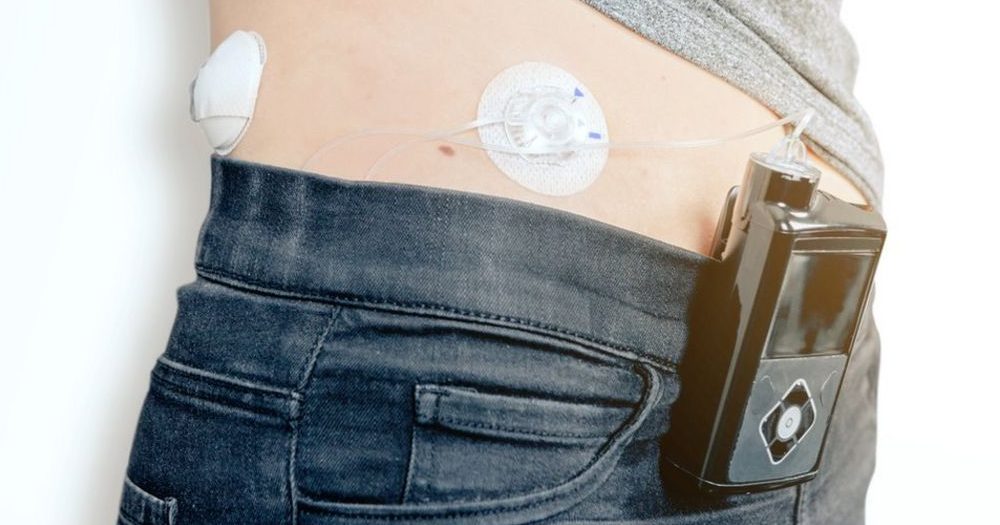 artificial pancreas - photo