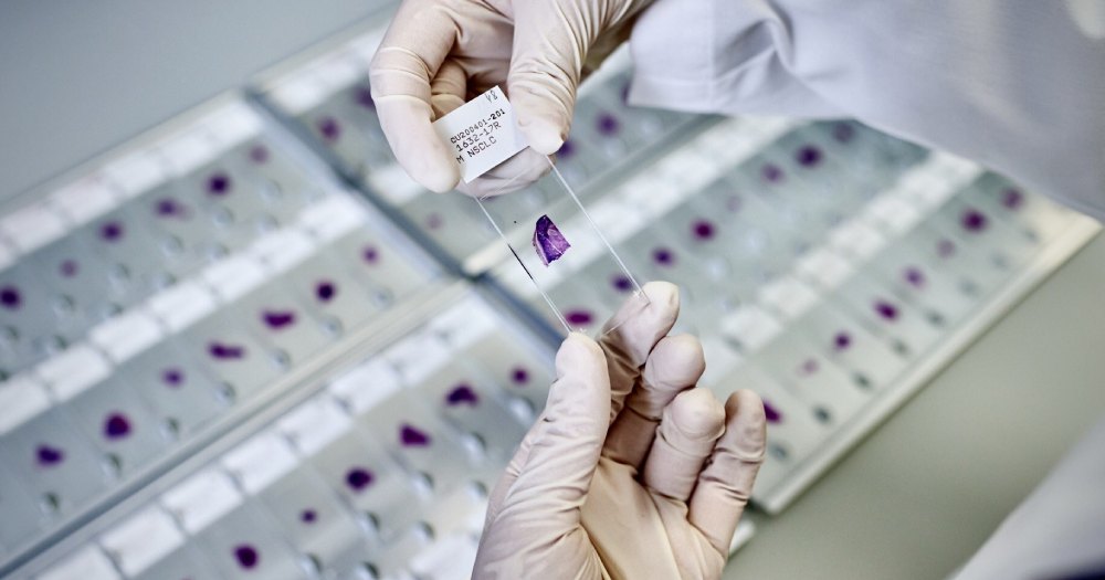Lunit, AstraZeneca working together on AI-powered digital pathology risk assessment tools for NSCLC
