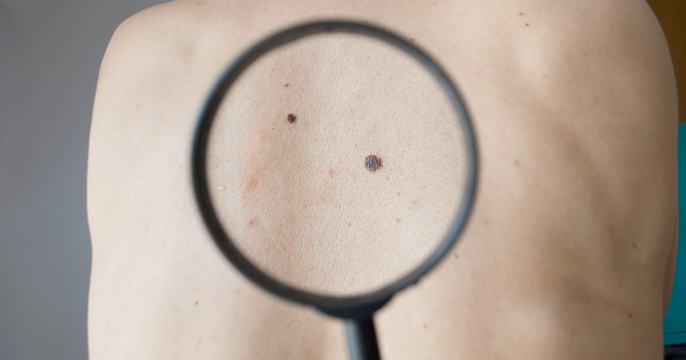 detecting melanoma